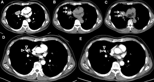 Figure 2 Computed tomography (CT)-guided percutaneous 125I seed implantation was performed. (A) CT scan before brachytherapy. (B and C) The procedure of CT-guided 125I brachytherapy was performed according to preoperative TPS, 18 G spinal needles were inserted to reach the tumor (arrows), seeds were released from deep to shallow (arrows). (D) One month after treatment, the lesion apparently shrunk (arrows). (E) Six months after treatment, the tumors disappeared, with only seeds remaining (arrows).