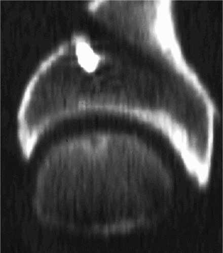 Figure 8. Sagittal CT image of hip joint after Bernese periacetabular osteotomy. The cortical screws fixating the acetabular fragment only resulted in minor artefacts probably because they were made of titanium which is known to cause few metallic artefacts.