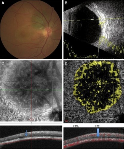 Figure 2 A case with a small and growing peripapillary choroidal melanoma.