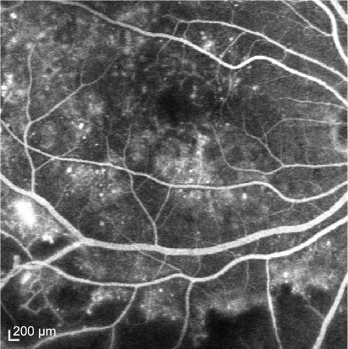 Figure 1 Fundus fluorescein angiogram at 45 seconds in a patient with ischemic diabetic macular edema.