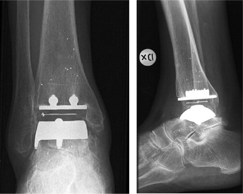 Figure 1. A-p and lateral radiographs of the ankle in case no. 1 at 4 years.