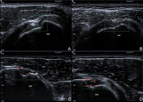 Figure 2 The blood flow signals. (A) Grade 0: no blood flow signals; (B) Grade 1: one or two dot-like blood flow signals; (C) Grade 2: three or four short linear blood flow signals; (D) Grade 3: branching or mesh-like blood flow signals.