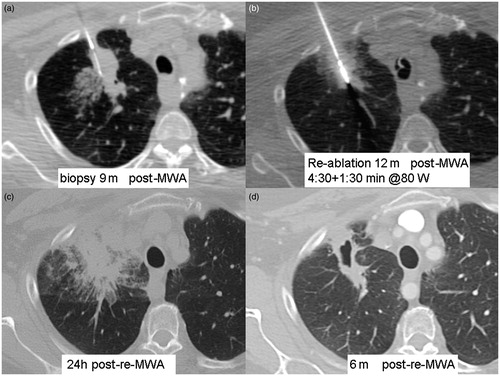 Figure 3. A 55-year-old patient with recurrence of right right upper lobe (RUL) non-small cell lung cancer (NSCLC) after 60 Gy of radical external beam radiation, treated with MWA. Residual avidity on FDG-PET scan 6 months post-ablation (see Figure 1Cb). (a) CT-guided core biopsy RUL lesion. (b) CT-guided microwave re-ablation 12 months after initial ablation (c) Axial CT scan 24 h after re-ablation shows large circumferential area of GGO and partial atelectasis. (d) CT scan 6 months after re-ablation shows cavitating non-enhancing ablation site.