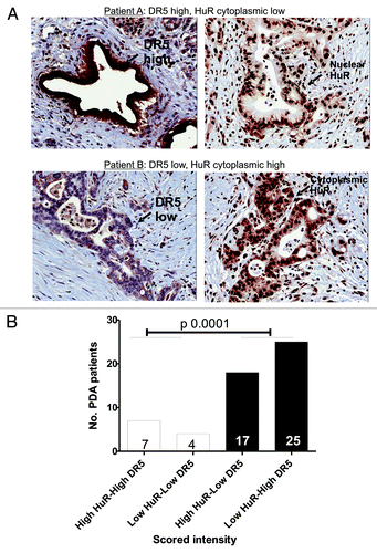 Figure 6. Correlation between HuR and DR5 in patient samples. A. The levels of cytoplasmic HuR and DR5 were assessed by immunohistochemistry (20× magnifications). The top panel (patient A) is a representative PDA specimen with low or absent cytoplasmic HuR (right) and a high DR5 intensity in the same tumor cells (left). The bottom panel (patient B) demonstrates a PDA specimen with elevated cytoplasmic HuR (right) in the tumor cells that also have a low DR5 intensity in the same cells (left) (Fig. 6A). B. Scores from 53 PDA specimens were calculated. Significant correlation was observed between DR5 intensity and cytoplasmic HuR levels (p 0.0001).