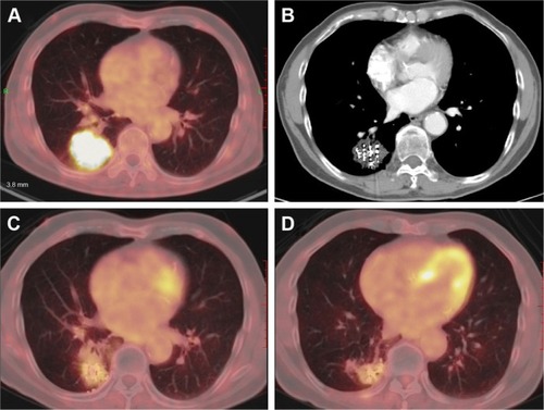 Figure 4 A 69-year-old male patient with adenocarcinoma of the right lower lobe who underwent 125I permanent brachytherapy 2 weeks after one cycle of the first-line chemotherapy.