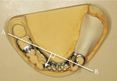 Figure 15 Indirect retention in denture design.