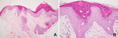 Figure 2 Histopathology: (A) mild epidermal hyperplasia with focal mound parakeratosis (hematoxylin-eosin, x100). (B) Higher magnification showed parakeratotic corneocytes with retained keratohyalin granules, which were more prominent around the eccrine ostia (hematoxylin-eosin, x400).