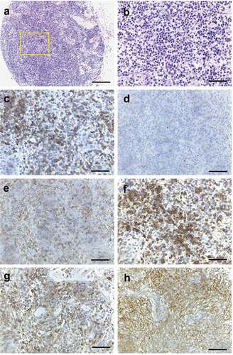 Figure 5. Histopathology of NSG mouse lymph node transplanted with enlarged lymph node cells from RHOA p.Gly17Val mouse. (a, b) H&E staining of single enlarged lymph node from transplanted NSG mouse. Note lymphocytic infiltration. (c) CD3 staining shows presence of T cells. (d) PAX5 + B cells are missing. (e) CD4+ cells are found. (f) HA staining shows presence of transgenic cells. PD-1 staining (g) and CD21 staining (h) are consistent with partial replication of original transgenic phenotype. Scale bars represent: 200 μm for A; 50 μm for the rest.
