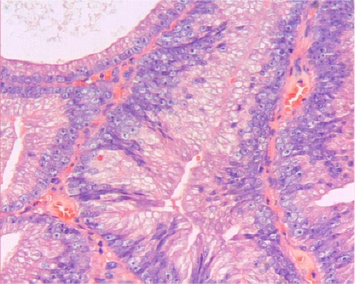 Figure 3 Prostatic ductal adenocarcinoma tumor cells are high columnar and amphophil, surrounded by abundant cytoplasm. Tumor cells are arranged in single or pseudostratified layers. Hematoxylin and eosin ×200.