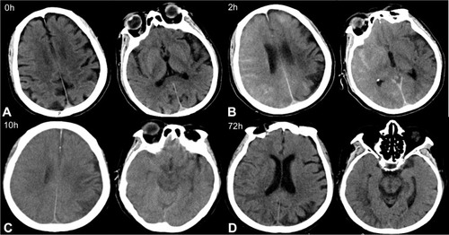 Figure 1 Contrast-induced encephalopathy in brain computed tomography (CT) scans. (A) Emergency brain CT showed no acute pathological findings. (B) Brain CT 2 hours after surgery indicated multiple high-density regions in the subarachnoid space. (C) Brain CT 10 hours after surgery showed significantly swollen brain tissue, particularly in the right hemisphere, the left frontal lobe, and the left occipital lobe. The high-density shading in the subarachnoid cavity was significantly denser than in previous scans. (D) Brain CT 72 hours after surgery showed the sulci of the right hemisphere became shallow, and low-density shadows could be seen in the frontal parietal lobe. But cerebral edema was significantly improved.