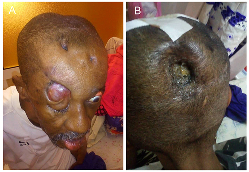 Figure 1 (A) Right orbital ulcerated wound in a patient with chronic multifocal cranial osteomyelitis caused by Klebsiella pneumoniae; (B) partial scalp wound.