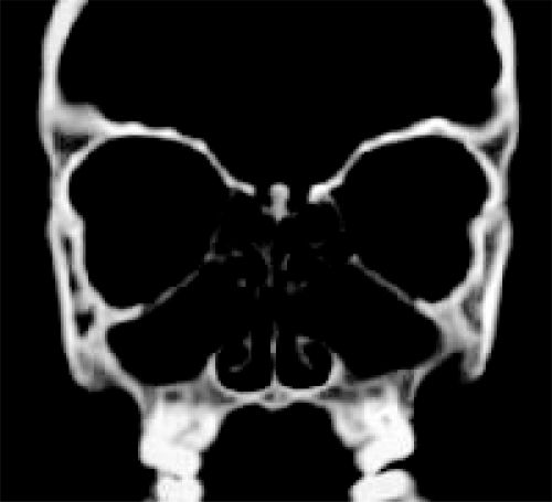 Figure 2 Coronal CT showing pan-opacification of the sinuses.