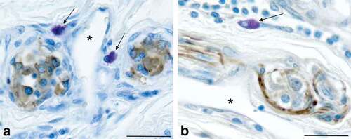 Figure 4. PrPC-expressing mast cells in the human carotid body are located within microns of blood vessels (indicated by asterisks) and neural elements (stained brown). Mast cells that express PrPC can be seen near type I CB cells that contain presynaptic vesicles stained with an antibody against synaptophysin (panel a) and axons stained with an antibody against neurofilament-l (panel b). Type I cells in the CB are innervated by peripheral nerve terminals of the carotid sinus nerve; most of the axons located in the CB are components of the carotid sinus nerve. The carotid sinus nerve terminates in the nucleus of the solitary tract in the brainstem, a known clinical target area for prion neuroinvasion. The proximity of the PrPC-expressing cells, permeable blood vessels and neural elements is consistent with the potential for prion neuroinvasion when there is a prionemia. Scale bars: Panels a, b = 20 µm.