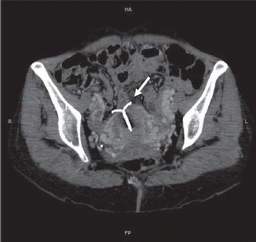 Figure 1. Contrast-enhanced MDCT of the pelvis at a venous phase. Coronal reformation in the great axis of the uterus shows a perforation of the uterine fundus wall by an intrauterine contraceptive device (white arrow).