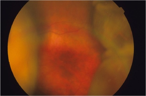 Figure 1 Fundus photography, left eye, demonstrating an example of nonappositional suprachoroidal hemorrhage that obscures the view of the optic disc.