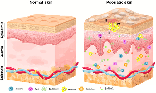 Figure 1 A simplified diagram illustrating the structural alterations in human skin affected by psoriasis. Normal skin structure (left) and compared with psoriatic skin (right). The formation of scaly, raised, red plaques on the skin, accompanied by I. acanthosis; II. parakeratosis; III. hyperkeratosis; IV. Munro’s microabscess. These plaques can be uncomfortable and itchy, causing pain and irritation.