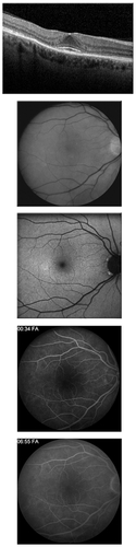 Figure 3 Spectral domain optical coherence tomography (SD OCT), red-free photo, fundus autofluorescence, and early and late fluorescein angiogram in patient 10, who had no symptoms, normal clinical exam and fundus autofluorescence imaging, Humphrey visual field 10-2 with paracentral scotomas, and “flying saucer” sign seen on SD OCT.