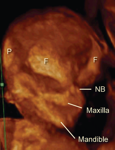 Figure 9.  3D maximum mode image of normal craniofacial structure at 11 weeks of gestation. Premature bony structure of frontal bone (F), parietal bone (P), nasal bone (NB), maxilla and mandible are recognizable.