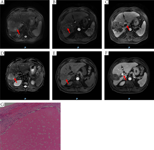 Figure 6 DCE-MRI and pathology of another HCC patient received conversion surgery. The red arrow points to the site of the tumor (A, B, D and E) or MPVTT (C and F). (A) an irregular mass on T2WI (10.4 x 7.3cm). (B) inhomogeneous enhancement of tumor at arterial phase. (C) MPVTT at venous phase. (D) the tumor was shrank on T2WI (6.6 x 4.7cm). (E) the tumor was shrank at arterial phase. (F) tumor thrombus in the MPV was disappeared at venous phase. (G) extensive necrotic tissue (HE, 100×).