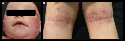 Figure 1 Clinical signs of atopic dermatitis in infants (A) and children (B). Photos courtesy of Dr Tanigushi Abagge. Caregivers and investigators authorized the publication of these photos.