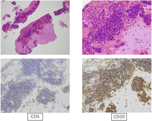Figure 2 Brain specimens (cranioscopic biopsy) showing infiltration of small monoclonal lymphocytes with expression of CD5 and CD20 (upper left, H&E ×40; upper right, H&E ×100; lowerleft CD5 ×100; lower right, CD20 ×100).