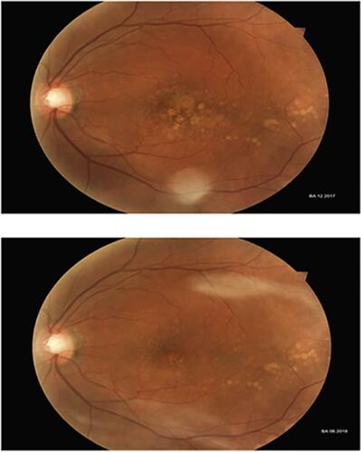 Figure 2 Fundus photograph showing the macular morphological features 6 months after using SNL therapy.