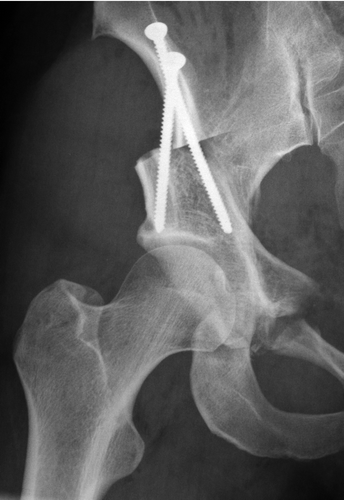Figure 3. Part of an anteroposterior pelvic radiograph showing the right hip after periacetabular osteotomy.