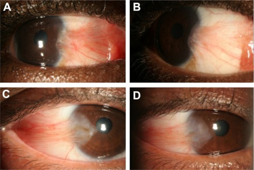 Figure 3 Representative photographs of a patient with significant improvement in conjunctival hyperemia after repeated subconjunctival ranibizumab injections, and photographs of a patient with only mild improvement in conjunctival hyperemia. Representative photographs of a patient with significant improvement in conjunctival hyperemia after repeated subconjunctival ranibizumab injections. (A) Preinjection photograph; (B) postinjection photograph. Representative photographs of a patient with only mild improvement in conjunctival hyperemia after repeated subconjunctival ranibizumab injections. (C) Preinjection photograph; (D) postinjections photograph.