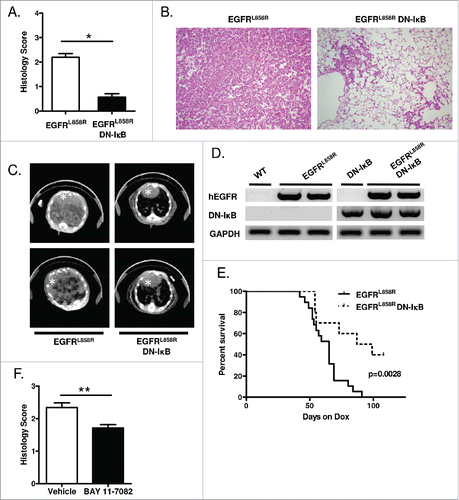 Figure 1. Epithelial NF-κB inhibition reduces EGFRL858R-mediated tumorigenesis. (A) Histological scoring of tumor burden, (B) representative H&E-stained lung sections (20x magnification), and (C) representative CT images from EGFRL858R and EGFRL858R DN-IκB mice administered dox for 5 weeks (n = 13–14 mice/group; *p < 0.0001). White asterisk designates the heart in CT images. (D) RT-PCR for EGFRL858R (hEGFR) and DN-IκB transgenes using mRNA isolated from lungs of WT, DN-IκB, EGFRL858R, and EGFRL858R DN-IκB mice administered dox for 5 weeks. (E) Kaplan–Meier survival curve of EGFRL858R and EGFRL858R DN-IκB mice after dox administration (for EGFRL858R n = 19 mice, for EGFRL858R DN-IκB n = 10; log rank test p = 0.0028). (F) Histological scoring of tumor burden in EGFRL858R mice administered dox and treated with BAY 11–7082 or vehicle control (n = 8/group; **p < 0.01).