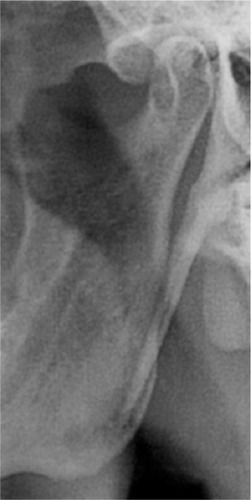 Figure 2 Type I – uninterrupted styloid process.