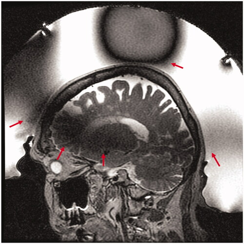 Figure 1. Transcranial MR guided focused ultrasound of an 87-year-old woman with essential tremor. Sagittal T2 weighted Fast Spin Echo (T2wFSE) treatment planning image of the brain acquired with the volume body coil shows the characteristic spatially varying signal loss through the thalamus and vertex (red arrows) due to the transducer array and water bath.