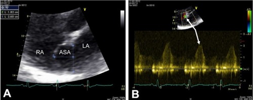 Figure 1 Transthoracic echocardiogram. (A) Four-chamber view with the use of zoom function demonstrates an ASA with a pronounced protrusion into the RA of 18 mm and a base width of 26 mm. (B) Color and PW Doppler echocardiographic examination reveals a small left-to-right shunt through a small PFO (white arrows).