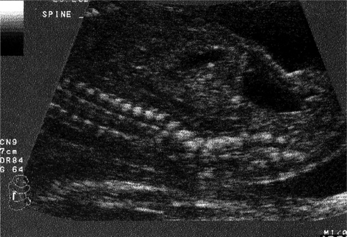 Figure 2 Longitudinal ultrasonographic scan of the spine of a second trimester fetus with hemivertebra.