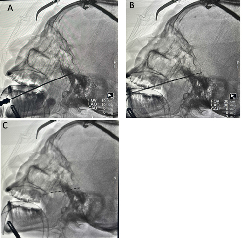 Figure 1 The X-ray image displays the location of the puncture needle at the entrance of the oval foramen on the affected side (A). The stimulating electrode is inserted through the oval foramen (B). After the removal of the puncture needle, the distal end of the electrode extends slightly beyond the petrous ridge (C).