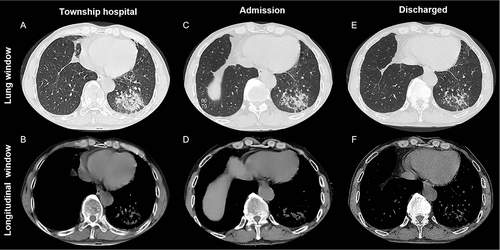 Figure 1 Chest CT image. The township hospital chest CT (A) lung window and (B) longitudinal window shows the left lower lung showed a mass of high-density shadow with vague edge, adjacent to the pleural retraction, and slightly dilated bronchioles in it. The admission chest CT (C) lung window and (D) longitudinal window shows the left lower lung showed a mass of high-density shadow with vague edge, adjacent to the pleural retraction, and slightly dilated bronchioles in it. The discharged chest CT (E) lung window and (F) longitudinal window shows the left lower lung showed stripped-like, patchy high-density shadow with clear boundary, adjacent to the pleural stretch, slightly dilated bronchioles, and more anterior absorption of the lesion.