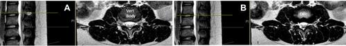 Figure 1 (A and B) The anterior border of the central canal is the posterior vertebral body at the vertebral body level (A). At the mid disc level (B) the lateral border of the central canal is the medial periosteum of the pedicles (arrow), and the posterior border is the lamina. The spinous process (SP) and lamina (L) are the posterior border of the central canal. The superior aspect of the superior articulating process (double arrow heads) is the posterior border of the neural canal The inferior articulating process (single arrow head) does not communicate with the neural foramen.