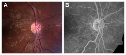Figure 2 (A) Color photograph and (B) fluorescein angiogram of the right eye 1 month after presentation.