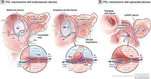 Figure 2. Examples of current LAAO devices and possible device-specific mechanisms of PDL at the time of device implantation. (a) Single lobe, membrane-coated devices such as the Watchman (Boston Scientific) interact with LAA in one circumferential zone at the level of the LAA landing zone where PDL may occur with these devices. In lobe and disc devices such as the Amplatzer Amulet (Abbott) interact with the LAA at two circumferential territories including the landing zone and then more distally in the body of LAA. These contact sites and the area between the lobe and disc represent potential regions where PDL can occur. The uniformity of LAA-device contact can be influenced by the presence of an additional lobe that can result in off-axis implantation and resultant PDL of both device types. (b) Leak following epicardial LAAO with the LARIAT device is always centrally located and could be modulated by the morphology of the LAA body and ostium. Purple and blue arrows represent (turbulent in some cases) flow into and out of the LAA , respectively. Abbreviations: LA, left atrium; LAA, left atrial appendage; LAAO, LAA occlusion; LSPV, left superior pulmonary vein; LIPV, left inferior pulmonary vein; LLR, left lateral ridge; MV, mitral valve; LV, left ventricle; PDL, peri-device leak; Cx, circumflex artery
