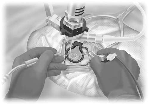 Figure 2. Schematic diagram showing the procedures for using the bipolar forceps and suction bimanually with a fixed rigid endoscope. The bimanual (bipolar forceps and suction) technique as visualized through the endoscope into the sheath.