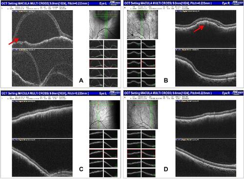 Figure 6 (A) OCT indicated limited detachment of the retinal neuroepithelial layer in the left eye, associated to SRF. (B) In the right eye, localized choroidal swelling was visible. The lesions were annotated with red arrows. After treatment of fulvestrant and CDK4/6 inhibitor, the SRF disappeared and retinas reattached (left: (C); right: (D)).