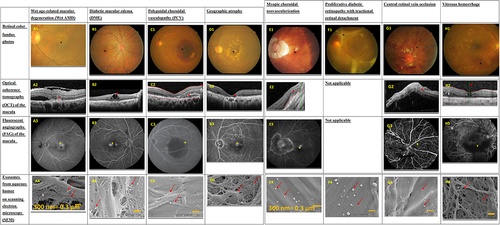 Figure 1. Aqueous humor exosomes in different ophthalmic diseases. Patient A: wet age-related macular degeneration (wet AMD); patient B: diabetic macular edema (DME); patient C: polypoidal choroidal vasculopathy (PCV); patient D: geographic atrophy; patient E: myopic choroidal neovascularization (myopic CNV). Patient F: proliferative diabetic retinopathy with tractional retinal detachment. Patient G: central retinal vein occlusion. Patient H: vitreous hemorrhage. Retinal color fundus photos (A1-H1), optical coherence tomography (A2-H2), and fluorescent angiography (A3-H3) were used to make the diagnosis×. Exosomes from aqueous humor were captured on anti-CD63 antibody-immuno-affinity modified filter paper, then images were obtained by scanning electron microscopy (A4-H4).