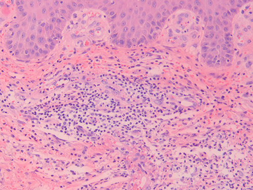 Figure 2 Histopathology of the ulcer near the right medial malleolus. (40×) H & E stain showing dense neutrophilic infiltrate in the dermis.