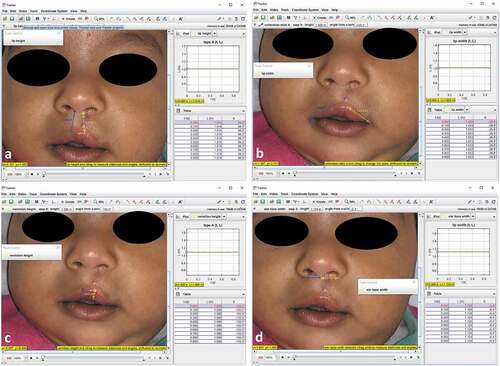 Figure 3. Anthropometric measurements on the patient (a: lip height), (b: lip width), (c: vermilion height), and (d: alar base width)