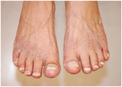 Figure 1. Pink scaly plaques in a moccasin distribution on dorsal surface of feet due to tinea pedis before antifungal treatment.