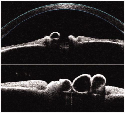 FIGURE 3. High resolution anterior segment non-contact optical coherence tomography (Visante™, Carl Zeiss Meditec, Inc.) of the iris flocculi of individual III:3. In the upper pane the cornea is shown in blue with the iris flocculi seen as cystic excrescences of the iris pigmentary epithelium at the pupillary margin (right eye). In the lower pane the iris flocculi are shown in higher magnification (left eye).