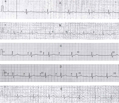 Figure 1. Serial electrocardiograms, lead II strips. (a): normal, 5 months prior to admission. (b): Complete third-degree atrioventricular (AV) block, at primary office 12 h before admission. (c): Type I second-degree AV block, 2 h after admission and antibiotic therapy. (d): first-degree AV block, 12 h after admission and antibiotic therapy. (e): normal, at discharge.