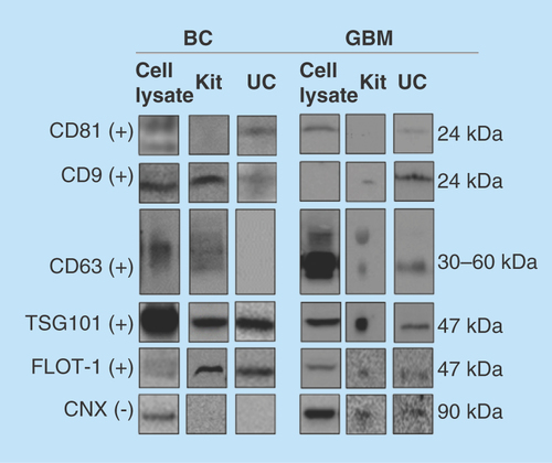 Figure 2.  Western blotting of common protein exosome markers.The protein markers CD81, CD9, CD63, TSG101, FLOT1 (positive markers, +) and CNX (negative marker, -) were targeted in cell lysates, and exosomes isolated by kit and UC (n ≥ 2). Monoclonal mouse antibodies were used for CD81, CD9, CD63, FLOT1 and CNX, while a polyclonal rabbit antibody was used for TSG101. For the BC exosomes, 15 μg protein was loaded for kit isolates and 3 μg for UC isolates. For the GBM exosomes, approximately 14 μg was loaded for kit isolates and approximately 8 μg for UC isolates. Uncropped western blots are presented in Supplementary western blots.BC: Breast cancer; CNX: Calnexin; FLOT1: Flotillin-1; GBM: Glioblastoma multiforme; UC: Ultracentrifugation.