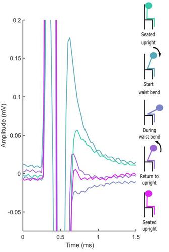 Figure 5 Stimulation artifact recorded with sub-threshold stimulation during a waist bend in clinical Subject #3. The color of the trace (left) corresponds to the color of the subject’s posture (right). No ECAP is present in these recordings, but a variable residual artifact manifests across the postural change.