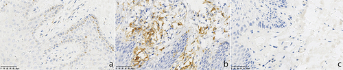 Figure 2 Expressions of CD123 in chronic eczema lesions and the perilesional normal skin at the edge (SP *400). (a) Epidermic of skin lesion. (b) Dermis of skin lesion. (c) Perilesional normal skin. (a) A few CD123+ monocyte-like cells with brown cytoplasm were observed in the epidermal of chronic eczema lesions. (b) More CD123+ monocyte-like cells with brown cytoplasm were observed in the dermal papillary layer of chronic eczema lesion. (c) Almost no of CD123+ monocyte-like cells with brown cytoplasm were observed in both epidermal and papillary layer of perilesional normal skin of the lesion.