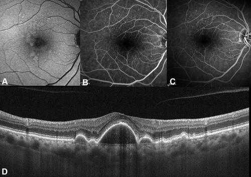 Figure 4 Cuticular drusen associated with large drusen. (A) Fundus autofluorescence shows the presence of large drusen appearing as faint hyperautofluorescent lesions. These large drusen are barely visible on fluorescein angiography during early phases (B) with minimal increase of hyperfluorescence during late phases (C). On spectral-domain optical coherence tomography B-scan through the foveal center, large drusen tend to coalesce into a drusenoid pigment epithelial detachment (D).